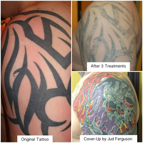 Tattoo Removal Cost How Much Is Tattoo Removal  Removery