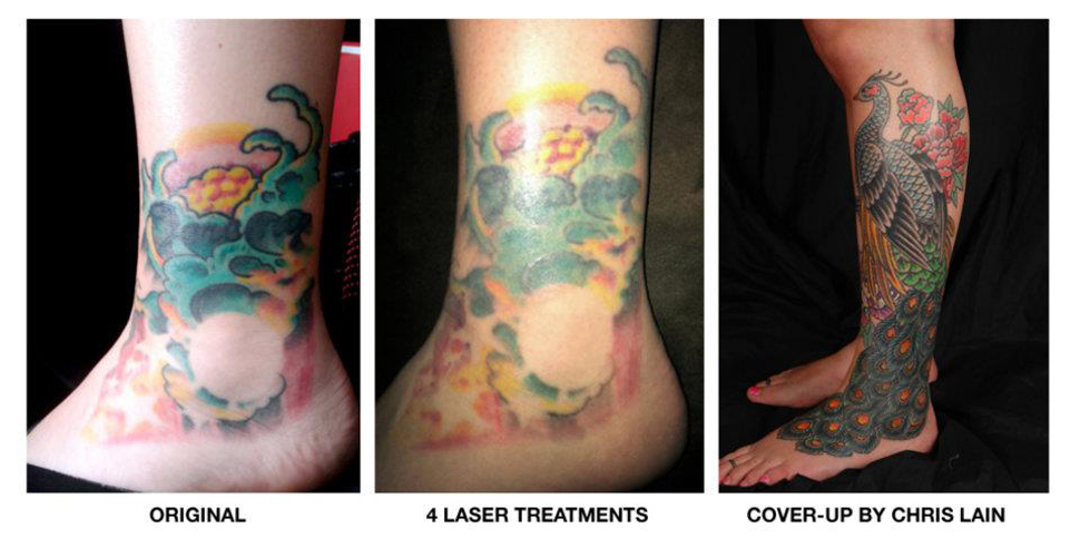 Tattoo removal special report  kiiitvcom