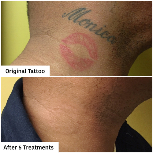 Laser Tattoo Removal  Pinnacle Tattoo