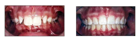 lori-smith-orthodontics_deep-overbite.jpg