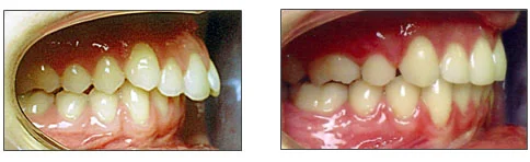 lori-smith-orthodontics_protruded-upper-teeth.jpg