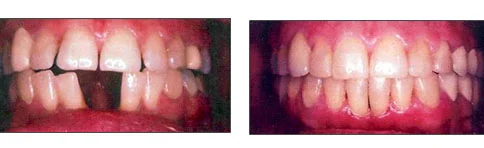 lori-smith-orthodontics_spacing.jpg