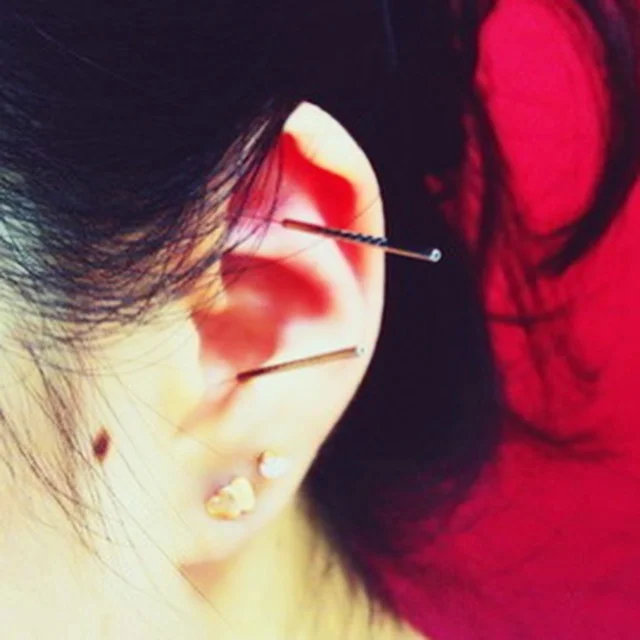 Auricular Acupuncture