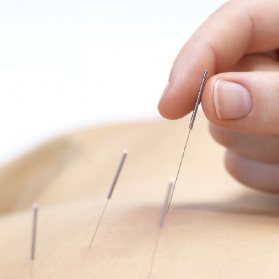 Acupuncture