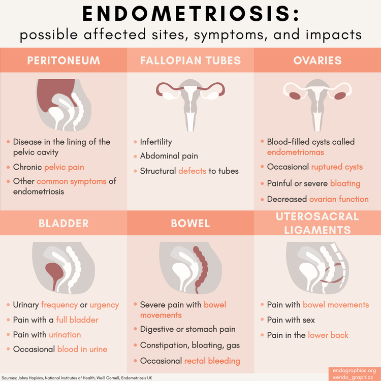 Body sites affected by endometriosis