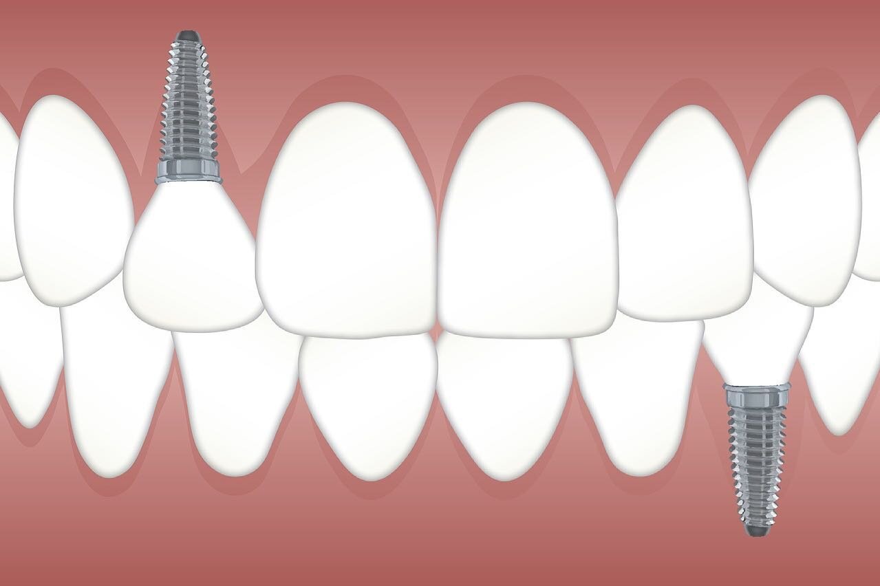 Forget about missing teeth, we have a solution!  Dental implants are a fantastic way to help restore your smile permanently. 😁

Dental implants are teeth that can look and feel just like your own!  With proper care, implants can last a lifetime. 

C