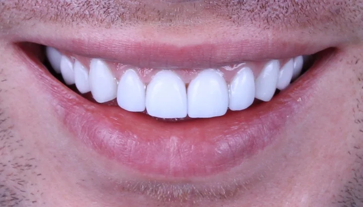 veneers.jpg