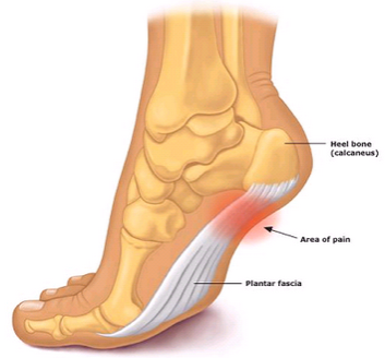 Plantar Fasciitis Foot Pain, Care 