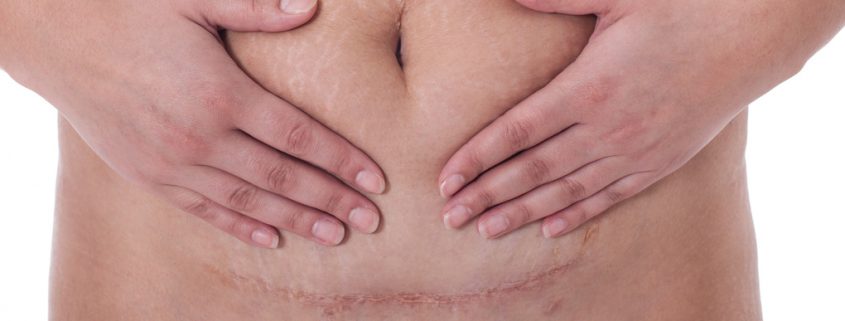 c-section-scar-845x321.jpg