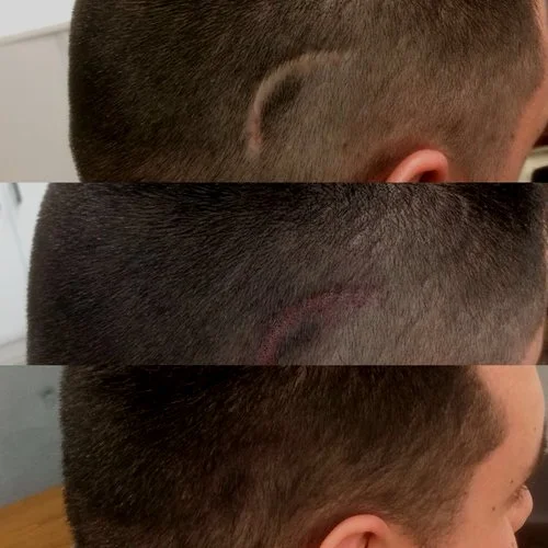 Three stage photo before and after treatments of scar tissue