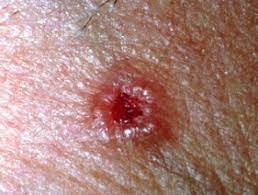 basal cell skin cancer.jpeg