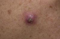 squamous cell skin cancer.jpeg