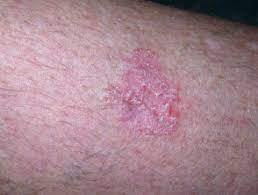 squamous cell carcinoma.jpeg