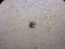 melanoma skin cancer.jpeg