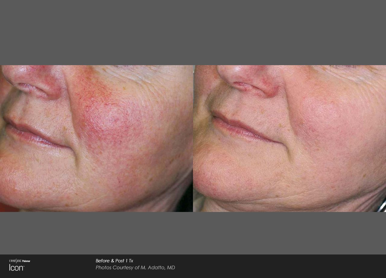 Skin-Revitalization-Before-&-After-Photo-5.jpg