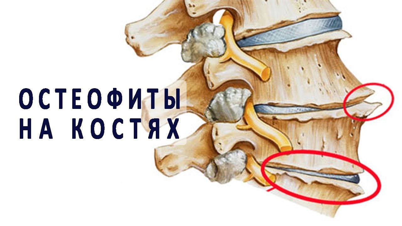 Остеофиты - что это, лечение, чем опасны, причины, симптомы