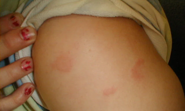 Urticaria2.jpg