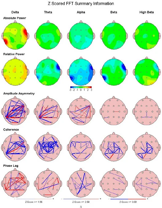 Sample qEEG brain map.