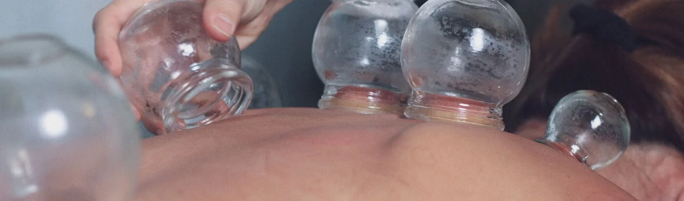 Cupping Therapy Treatment in Wilton Manors.jpg