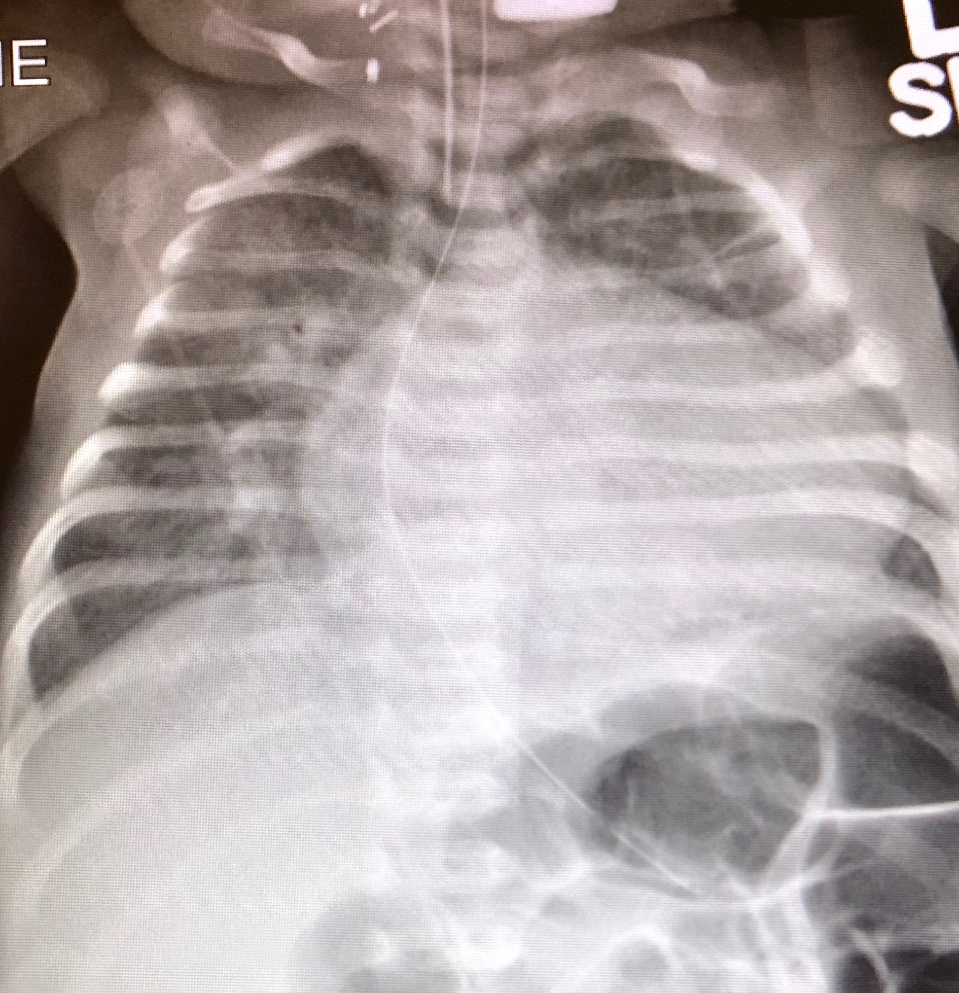 This is my heart on 4/27/18. Read more below about Idiopathic Dilated Cardiomyopathy...that is my vague diagnosis. 