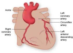thi-coronary-arteries-250x183.jpg