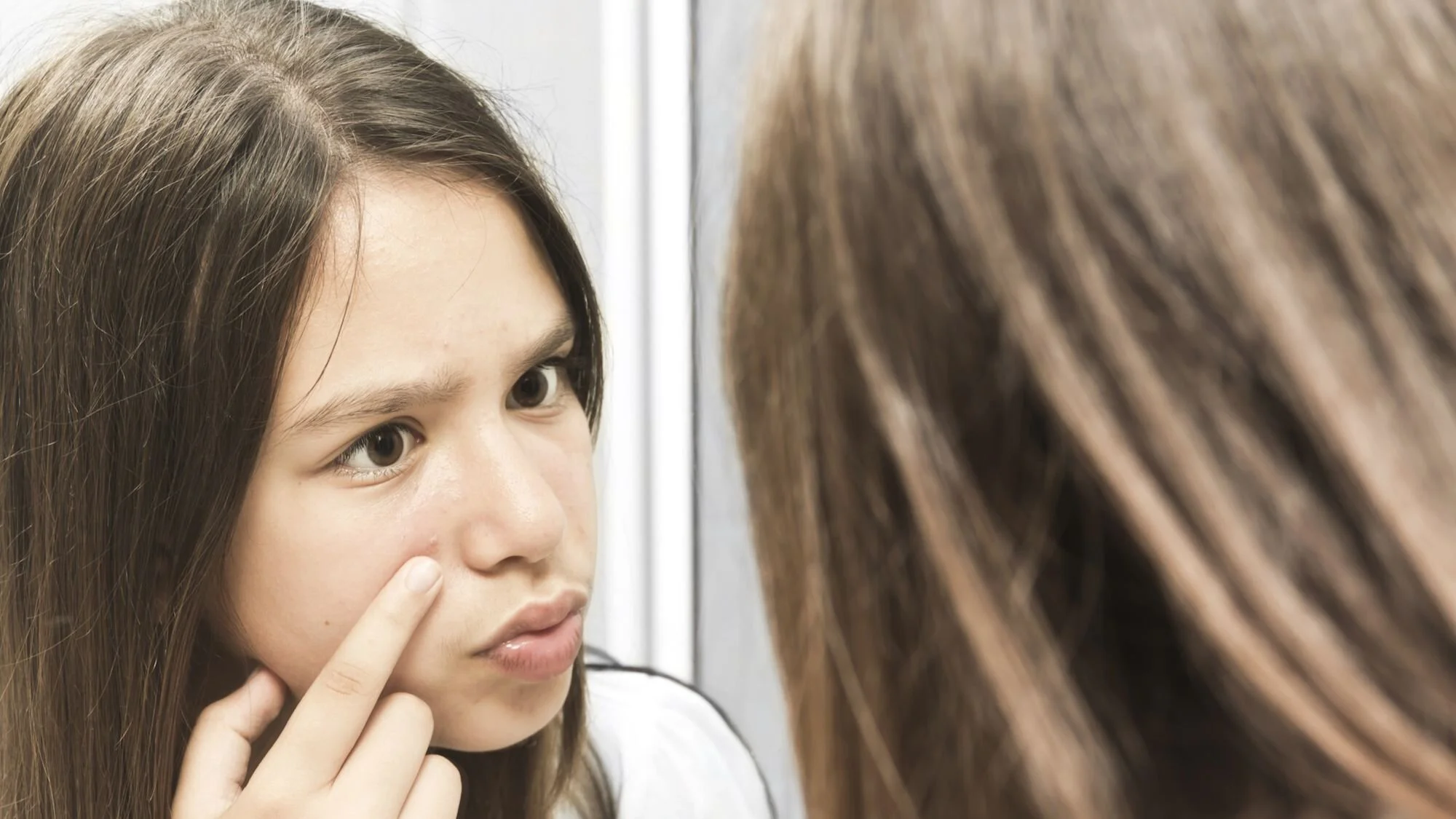 Acne And Abnormal Female Hair Distribution- Hirsutism