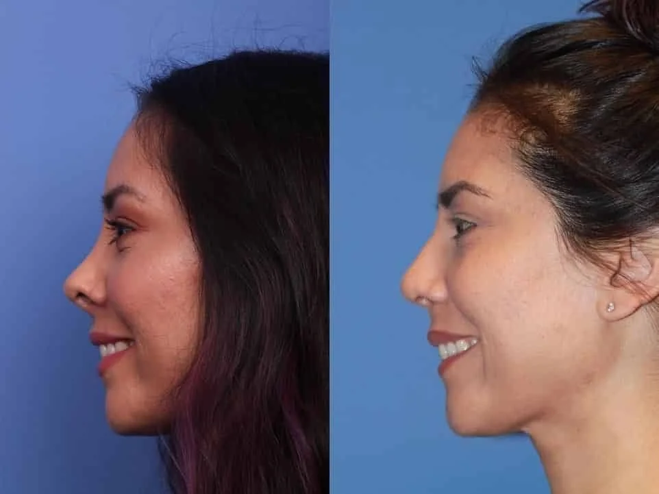 Rhinoplasty What to expect before and after a nose job? — Medipulse