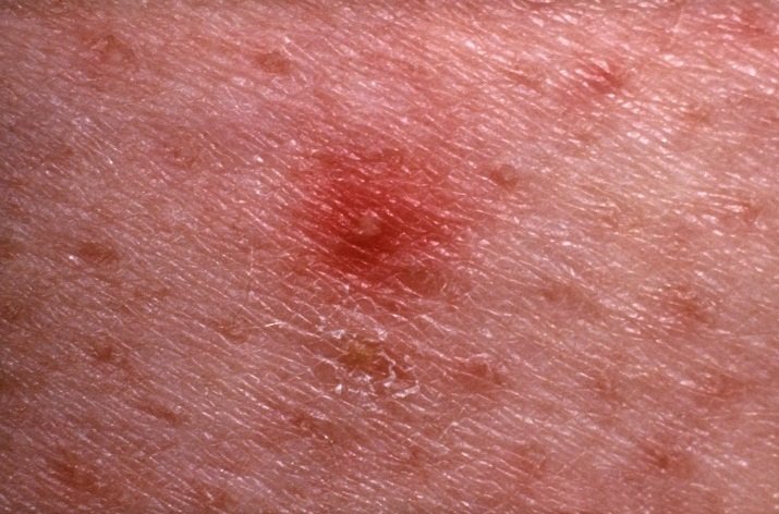 13 causes of red spots on the skin — Medipulse: Best Private