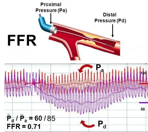 What Are The Benefits Of Using FFR In Angiograms? — Medipulse Best