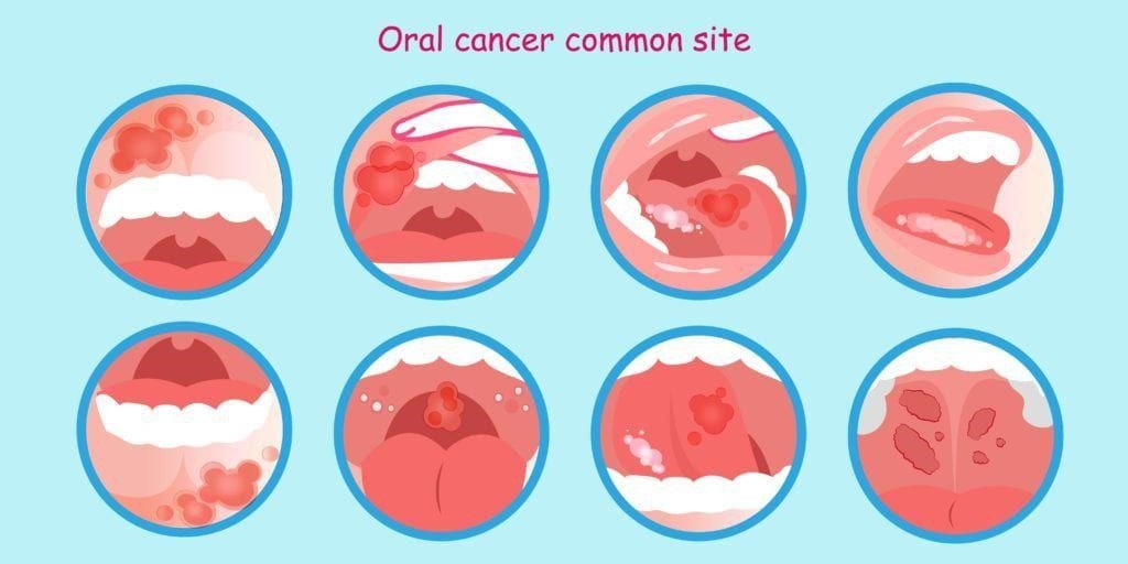 Everything To Know About Oral Cancer Causes Risks And Prevention