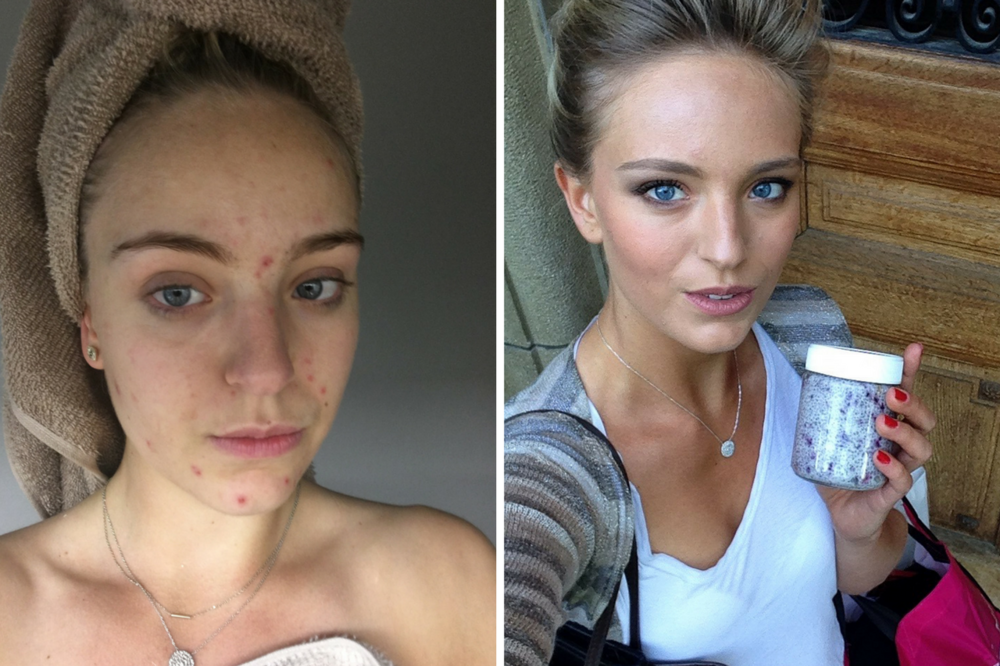 My Acne Story and Horrific Experience with Roaccutane — Wholesome Stef