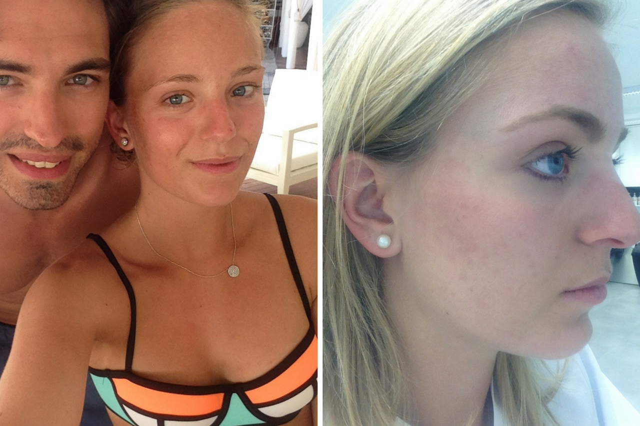 Horrific experience with Roaccutane