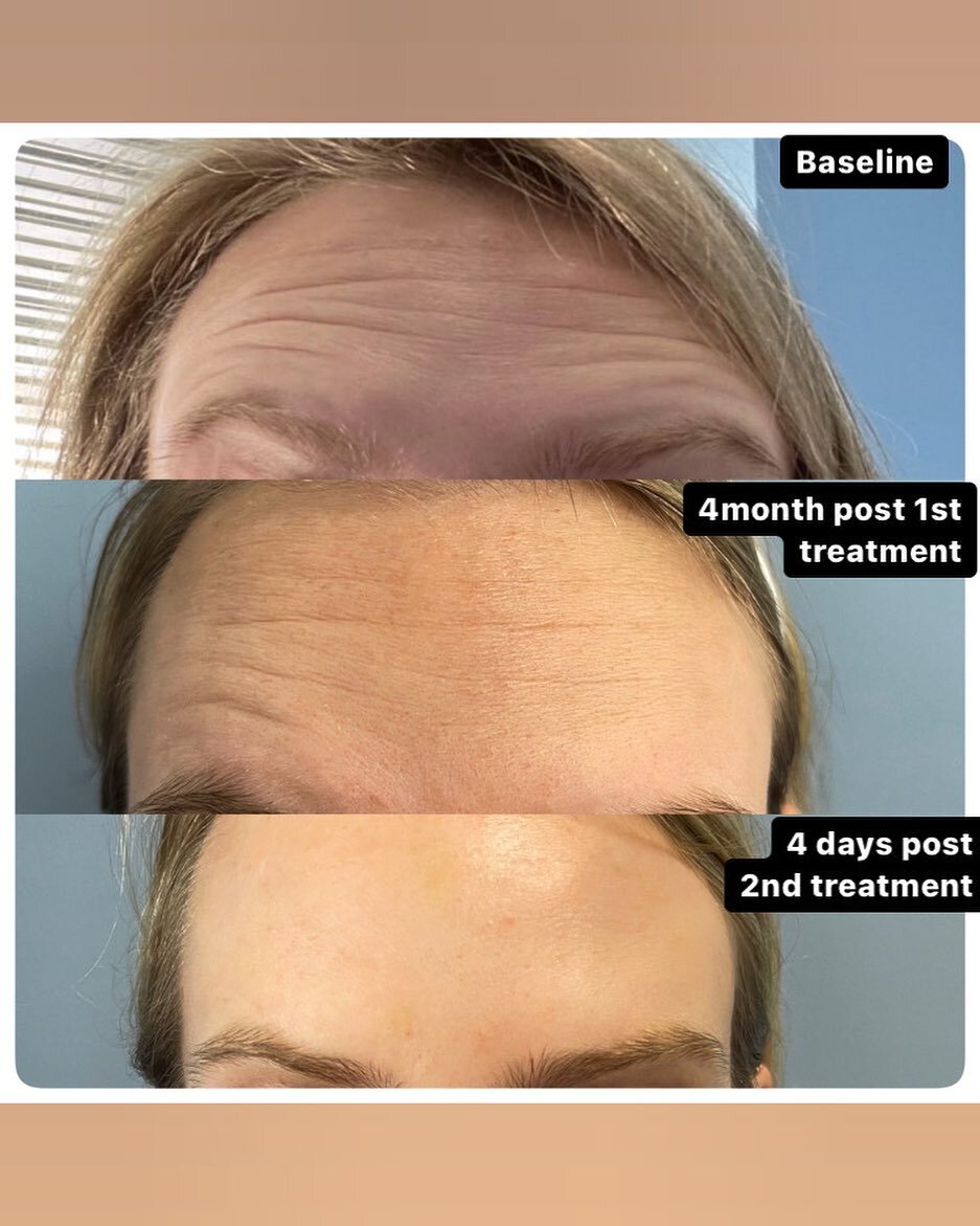 ✨NEUROTOXIN TIME✨

This 24 year old patient noticed her forehead lines become more prominent in recent years. 

We completed 1 treatment of Botox in January and then her second treatment in May . 

Call and book your appointment today (561)717-2277📲