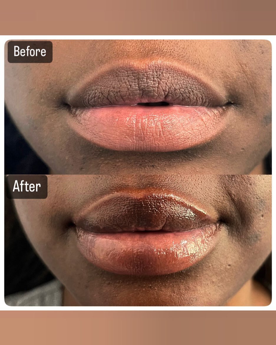 ✨HELLO LIPS✨

This patient wanted to add more volume to her lips for a more pouty appearance 💋

1 syringe of filler was used to achieve the patients desired result. 

Call and book your appointment today (561)717-2277📲 

#barnettdermatology #medica