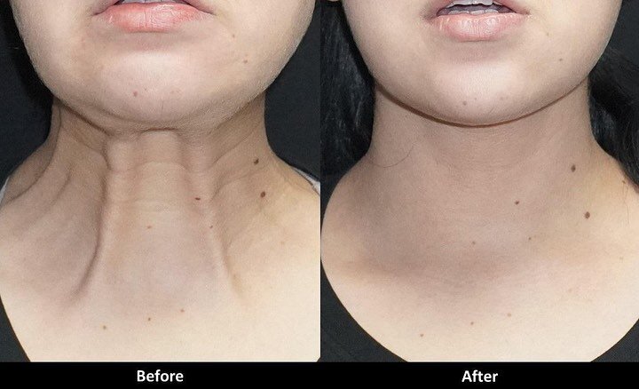 ✨BOTOX FOR NECK BANDS✨ 

When injected into the vertical bands of the neck, Botox can relax the dynamic muscles, making them less prominent, and resulting in a smoother, younger looking neck.

Come see us here at Barnett Dermatology and let&rsquo;s t