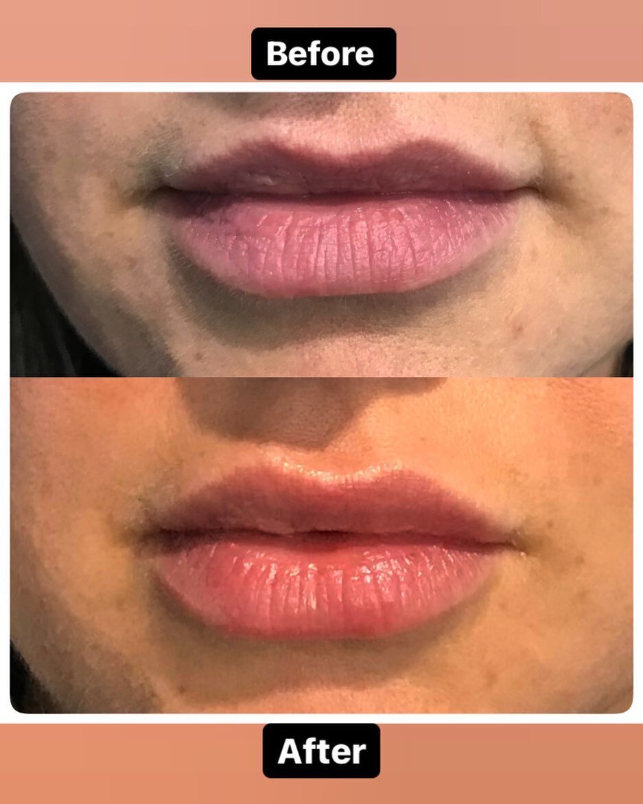 ✨SUMMER LIPS✨

This wonderful patient wanted a subtle lip augmentation and she loved the results 💋 

Call and book your appointment today (561)717-2277📲 

#barnettdermatology #medicaldermatology #cosmetics #fillers #botox #bocaraton #laserhairremov