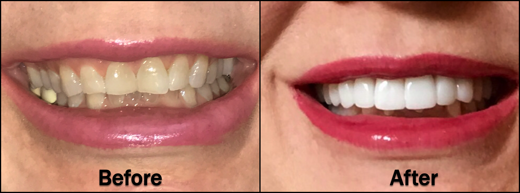 A current Lone Star Family Dental patient recently completed a cosmetic full-mouth case procedure.