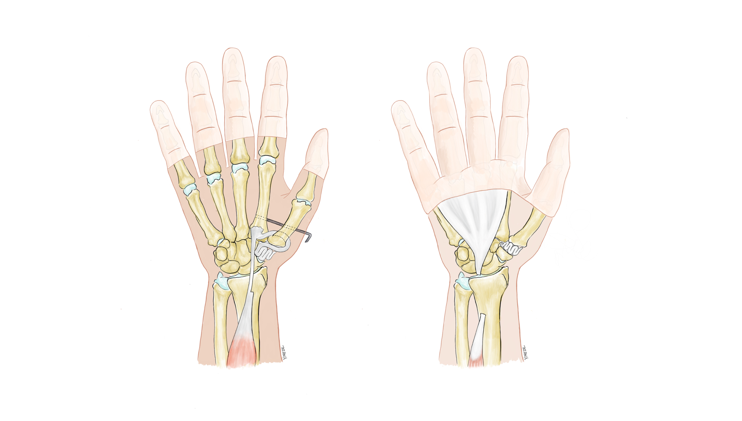 Partial Versus Total Trapeziectomy Thumb Arthroplasty: An Expertise-based Feasibility Study
