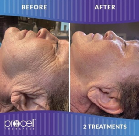 Procell Anti-aging