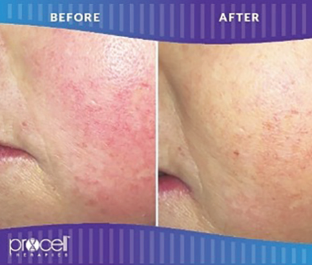 Procell Skin Texture