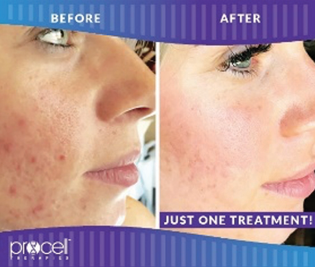 Procell Acne Scarring