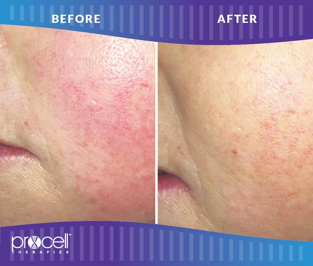 ProCellRosacea_B_A-001.JPG