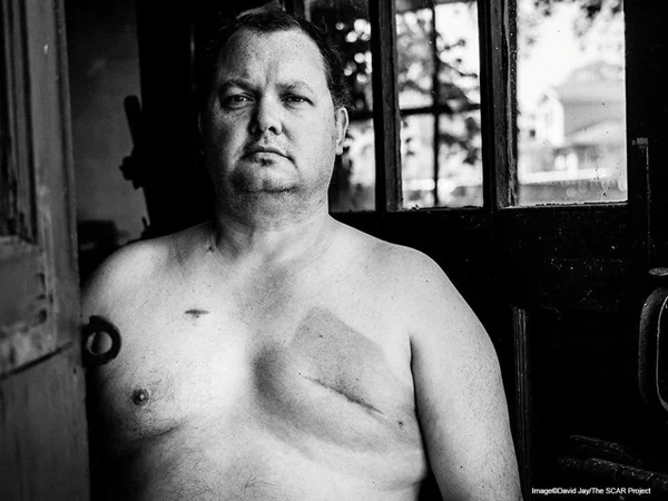 Photo by David Jay for The SCAR Project Before he died, Bill Becker participated in a portrait for The SCAR Project. Learn more at thescarproject.org.