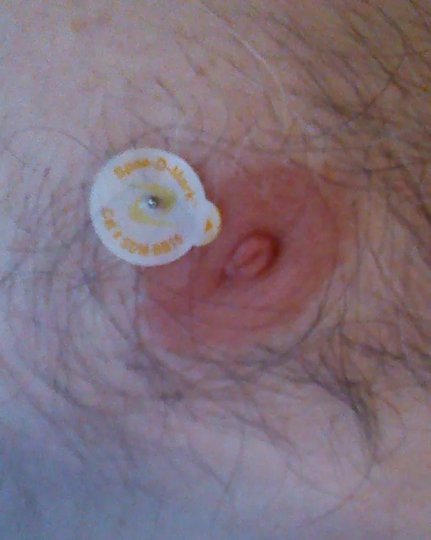 Before my mammogram they put a Spee-D-Mark sticker on me to help quickly indentify the location of my nipple and the lump in the imagry. 