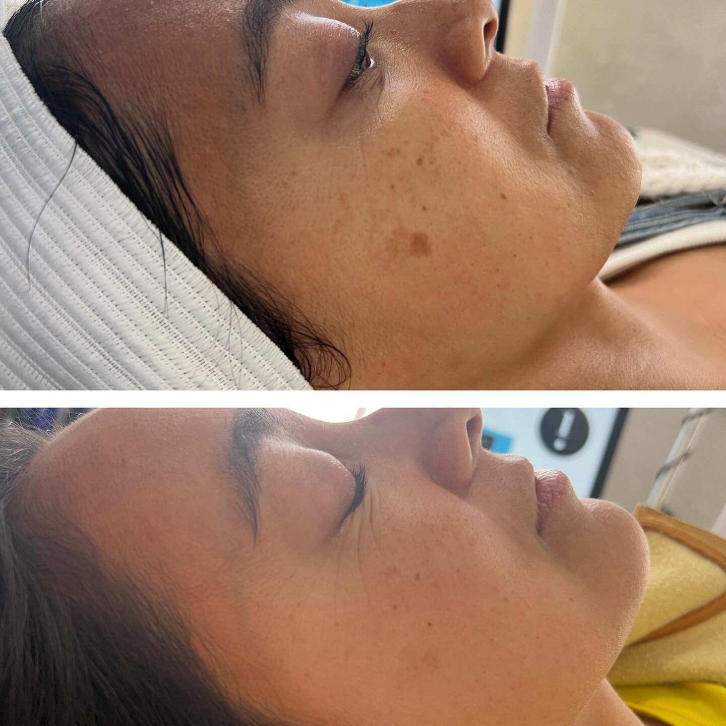 So happy for my clients progress after 1 CosmelanMD treatment, we just did the second application and can&rsquo;t wait to see the results 😍😍

#cosmelanMD #chemicalpeel #beforeandafter #hyperpigmentation