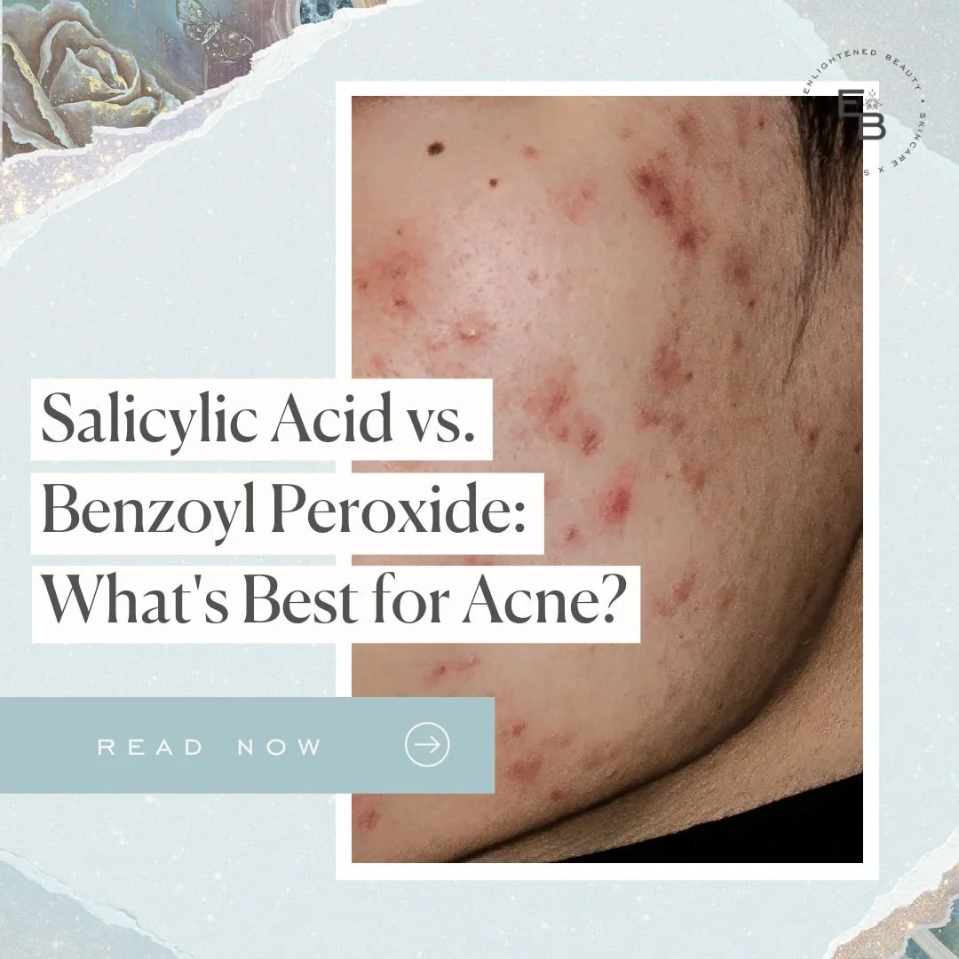 Salicylic Acid vs. Benzoyl Peroxide: What's Best for Acne?