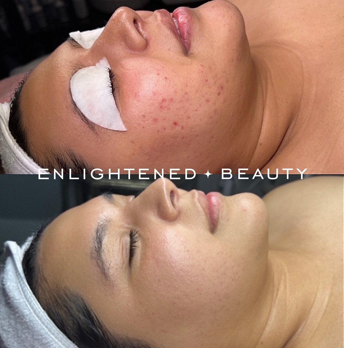 Like butta 🧈

Homecare + Treatments + Consistency + Trust 🥣

Beautiful skin is in reach 🫴🏼 

To schedule head to my website, EnlightenedBeautySacramento.com 🩷

#Enlightenedbeautysacramento #skincare #sacramentofacials #sacramentoesthetician