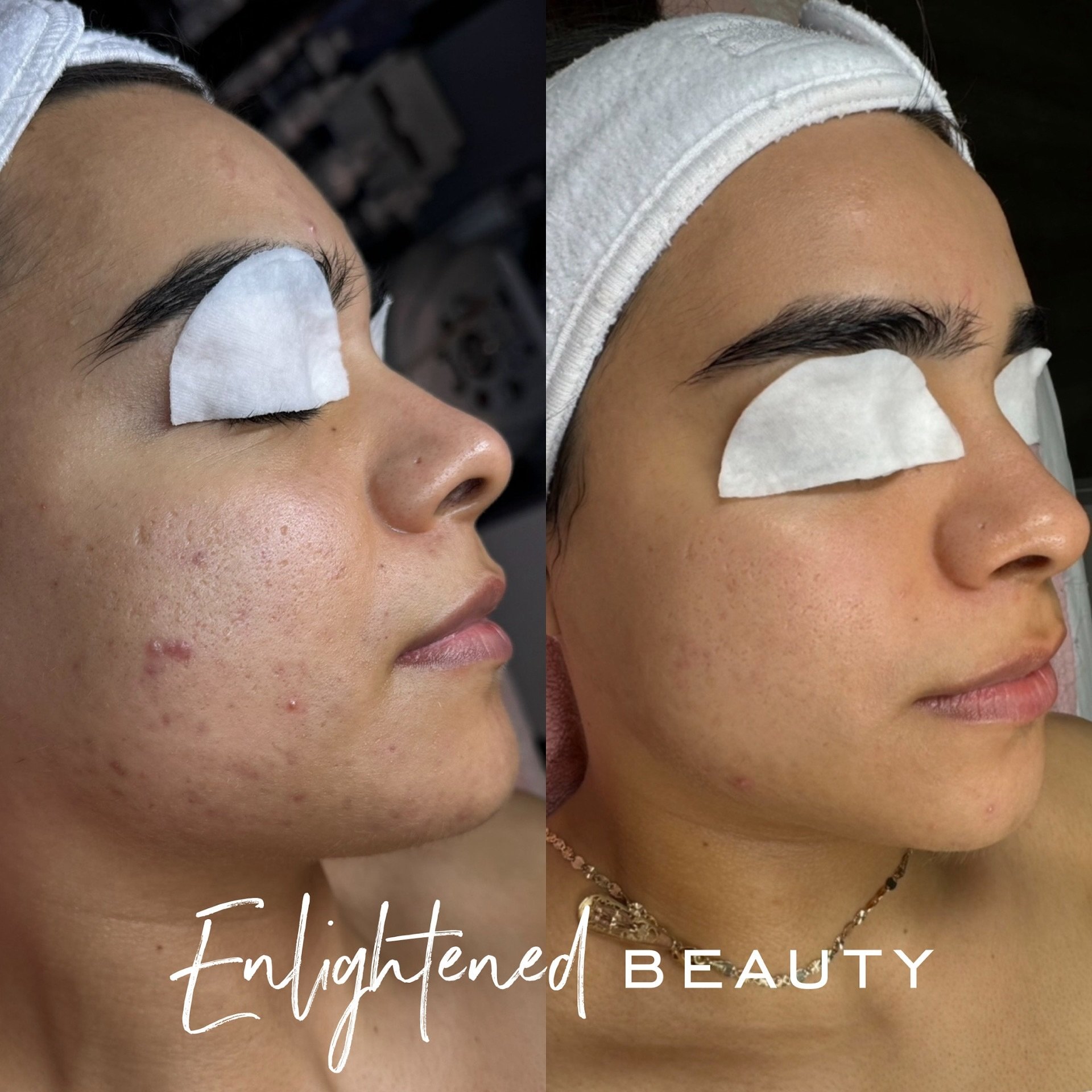 A clients commitment to their skin journey is the most important aspect to a successful, results driven esthetician. 
⠀⠀⠀⠀⠀⠀⠀⠀⠀
This client drives over 2 hours to get to her monthly appointments and is consistent with her home care and my recommendat