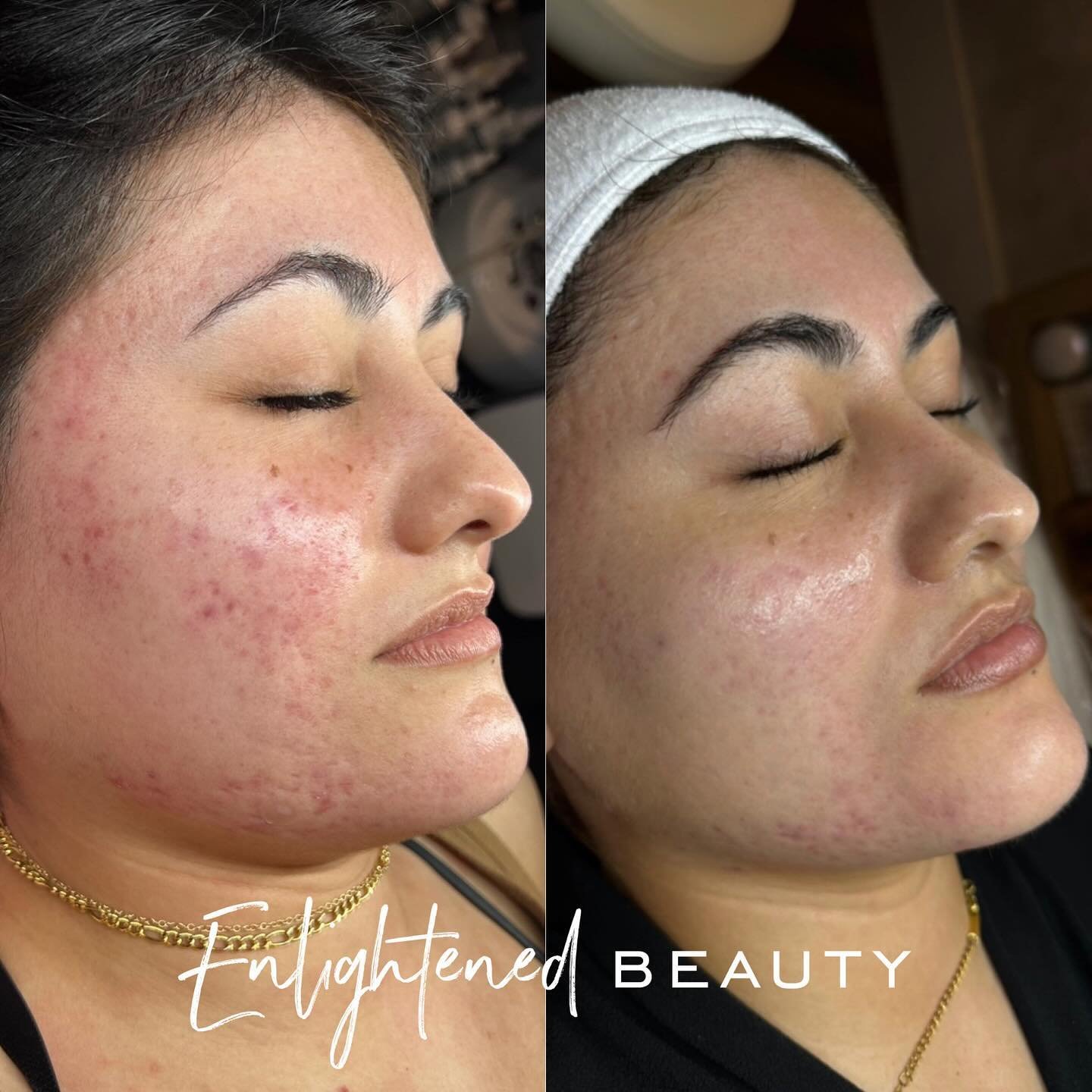 We have been working so hard to get her skin as close as possible to what it was before she had a single break out.

We have made so much incredible progress with deep treatments and strict homecare. Seeing this makes me SO EXCITED for my new device 