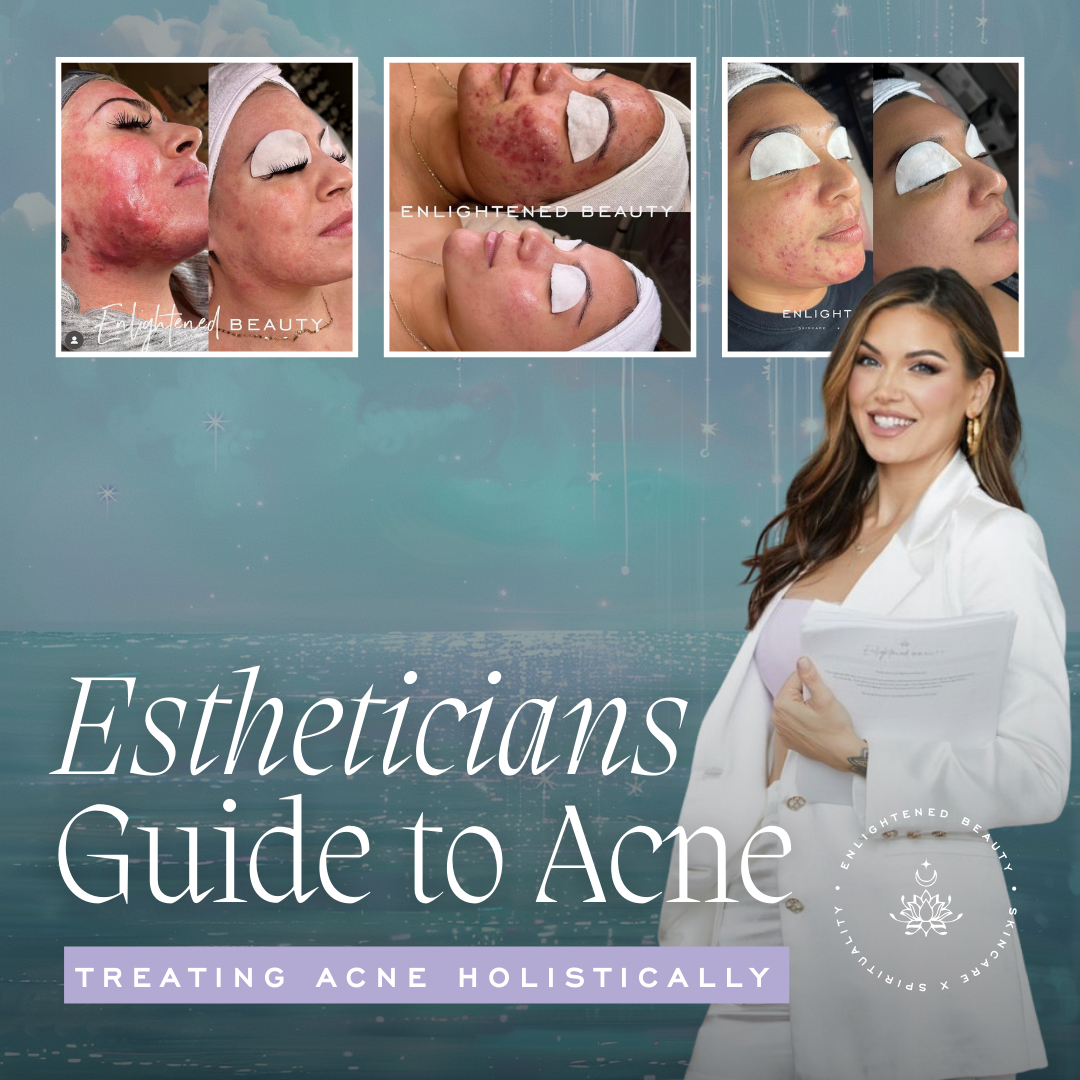 Holistic Estheticians Guide to Treating Acne